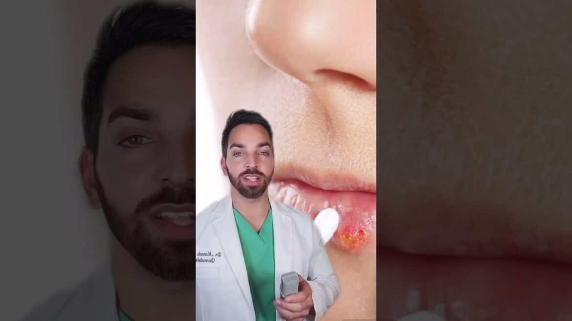 COLD SORES ON THE LIPS? #shorts