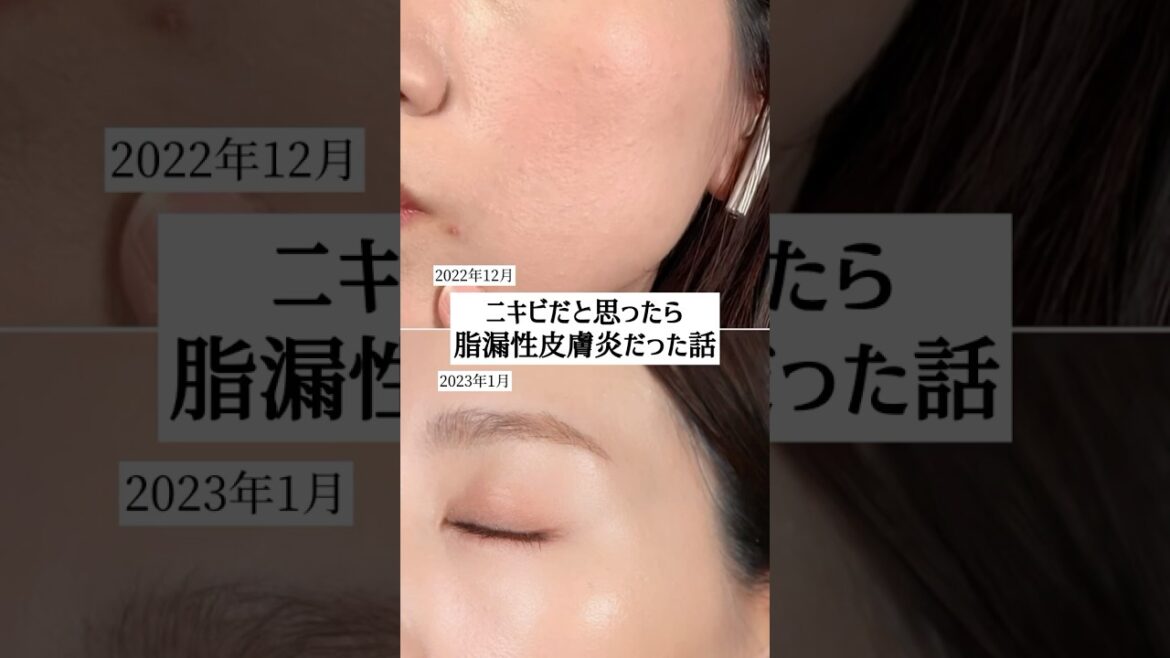 【ニキビだと思ったら脂漏性皮膚炎だった話】#脂漏性皮膚炎 #ニキビ #ニキビ改善 #吹き出物