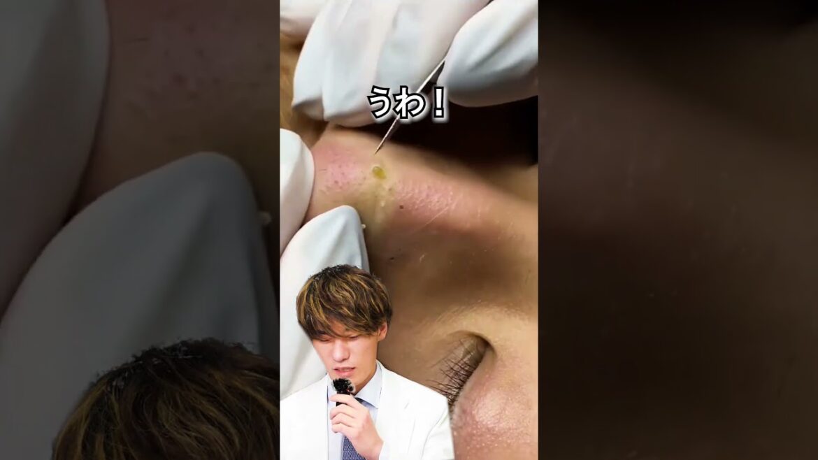 【毛穴の黒ずみ】みんな大好きにゅるにゅる鼻の角栓を丁寧に除去！#shorts