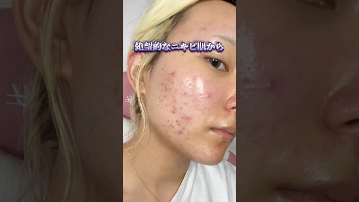ニキビ肌から褒められ肌になるスキンケアルーティン🫶🏻#shorts #skincare #skincareroutine #スキンケア #スキンケアルーティン #ニキビケア #垢抜け #おすすめ