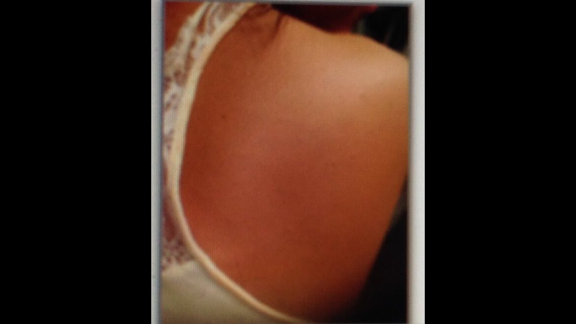 Acne Scar Cover Airbrush Your Body Flawless Perfect Waterproof Skin! Secret Bonus Step Included Prom Acne Scar Cover Airbrush Your Body Flawless Perfect Waterproof Skin! Secret Bonus Step Included Prom