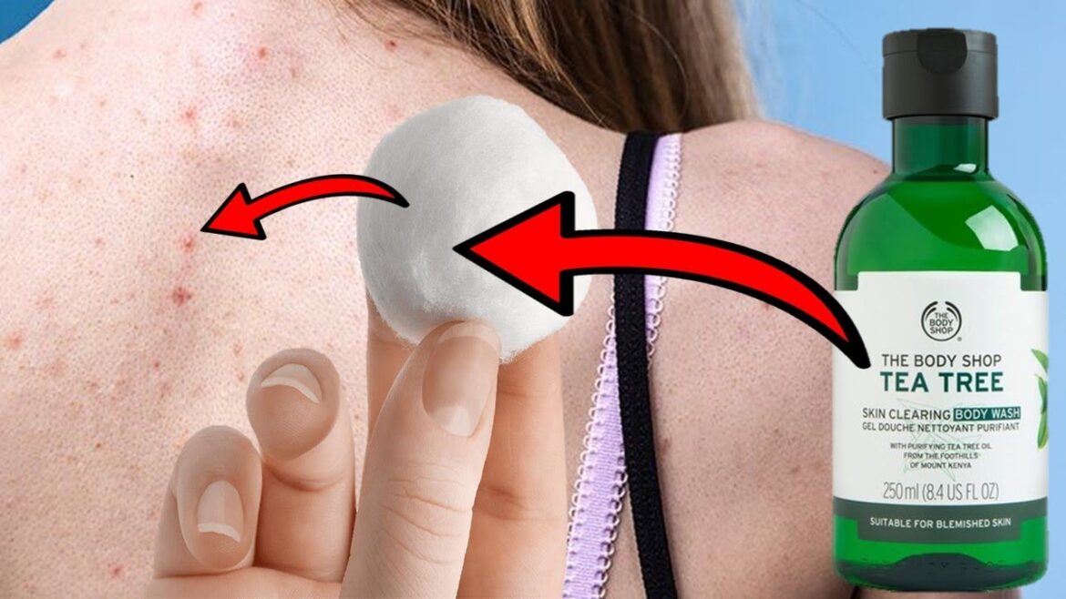 背中ニキビにティーツリーオイルを使う方法