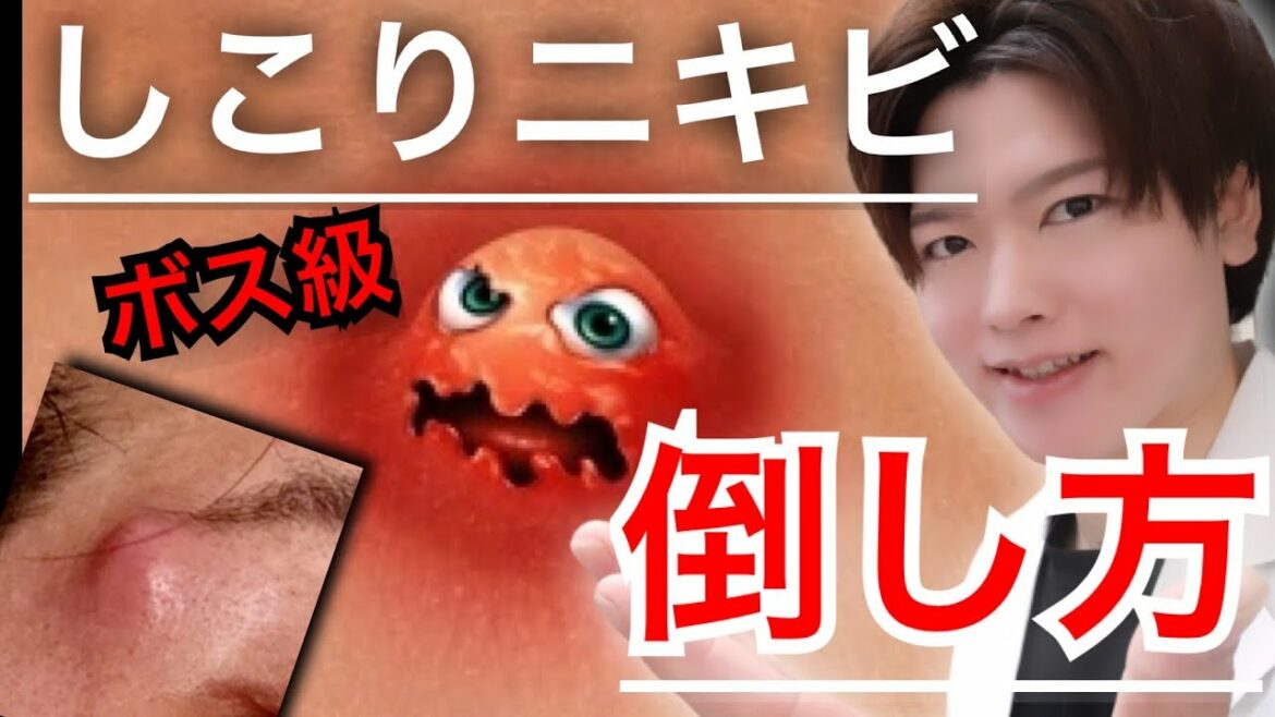 【ニキビ痕にしない】ボス級 巨大ニキビの倒し方
