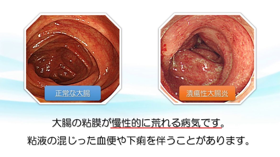 潰瘍性大腸炎【ららぽーと横浜クリニック】