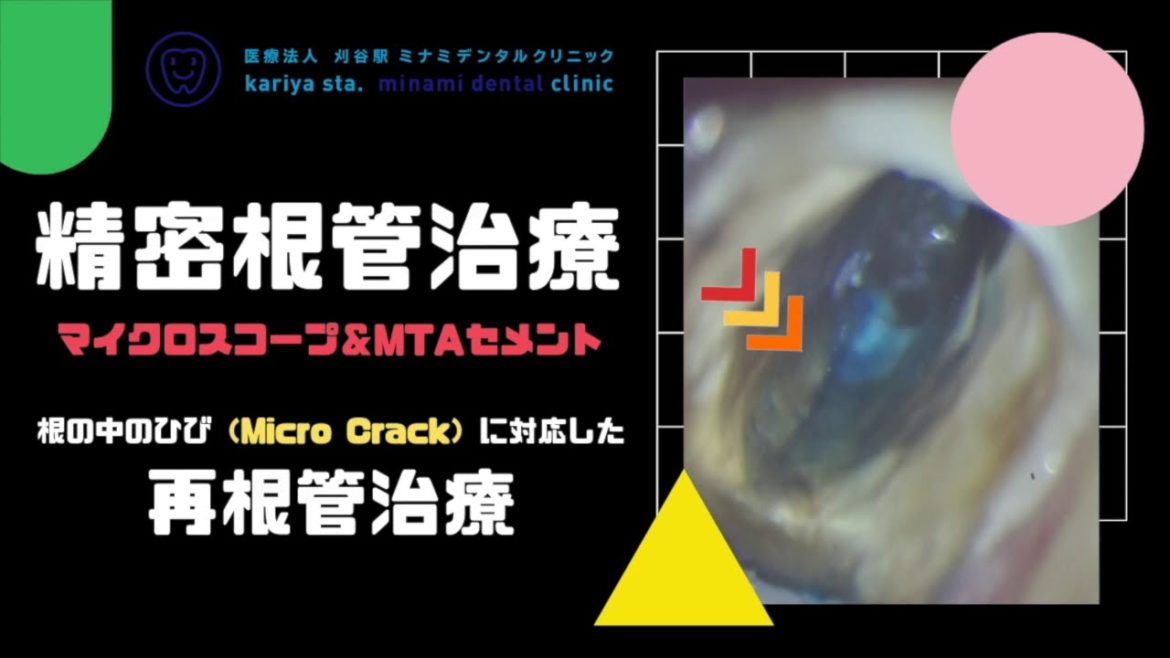 精密根管治療 　【愛知県刈谷市の歯医者】　歯根破折診断　マイクロクラック　亀裂　再根管治療　バイオセラミックス　オンライン診療　自由診療　顕微鏡歯科　マイクロスコープ　Kariya city