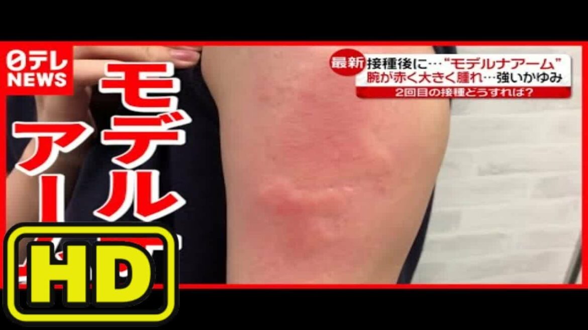 強いかゆみ＆赤い腫れ モデルナ製ワクチン接種後に多く確認（2021年7月15日放送「news every.」より）