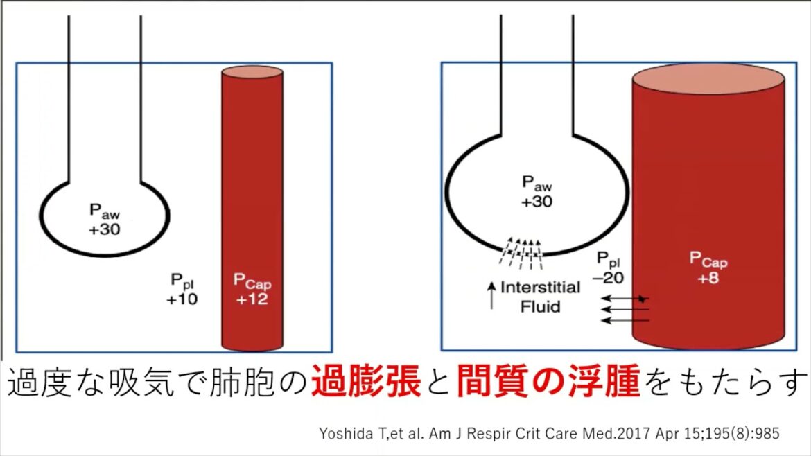 新型コロナウイルス感染者の自宅・宿泊療養における呼吸状態の観察とアセスメント【解説：岩田充永（藤田医科大学病院　救急総合内科）】