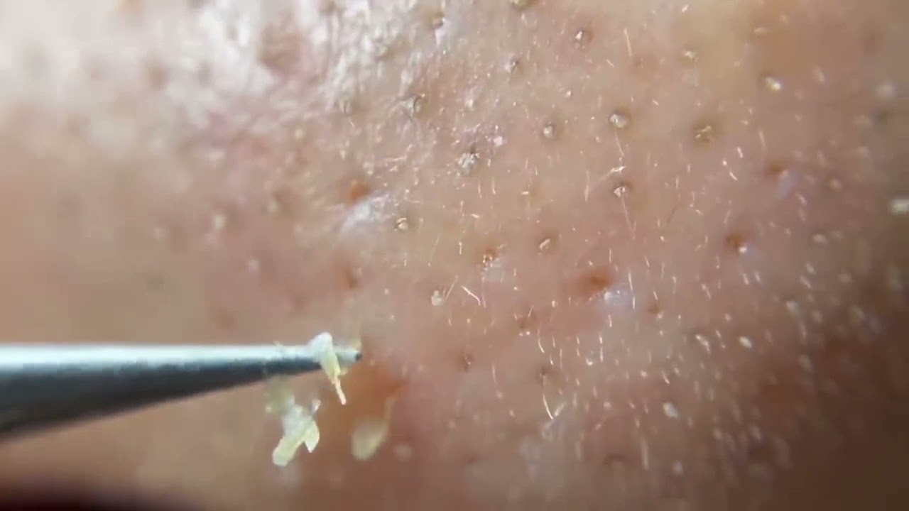 佐々木 希 スポスポ ただただ鼻の角栓を抜く動画 Blackheads News Wacoca Japan People Life Style 佐々木 希 スポスポ ただただ鼻の角栓を抜く動画 Blackheads News Wacoca Japan People Life Style