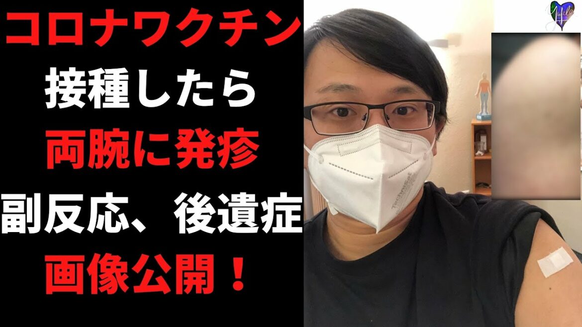 【閲覧注意】ドイツでコロナワクチン接種してきた結果、両腕に・・・【発疹】