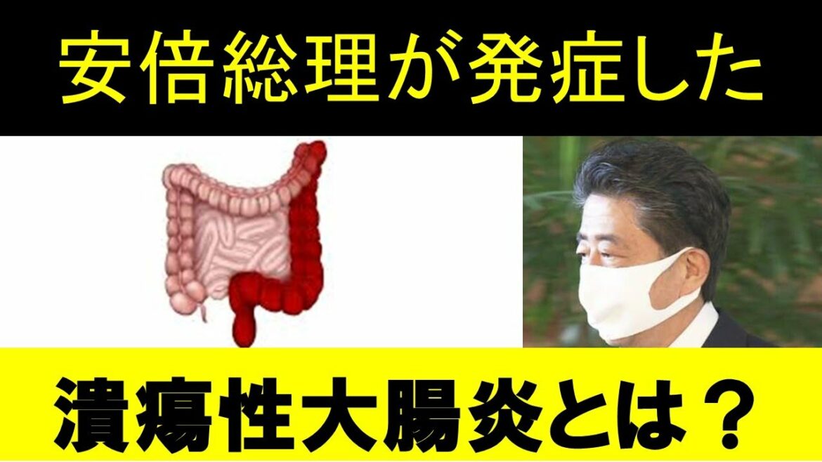 【安倍首相が辞意表明】潰瘍性大腸炎を発症！潰瘍性大腸炎の症状や治療、気をつける食事療法について解説します！