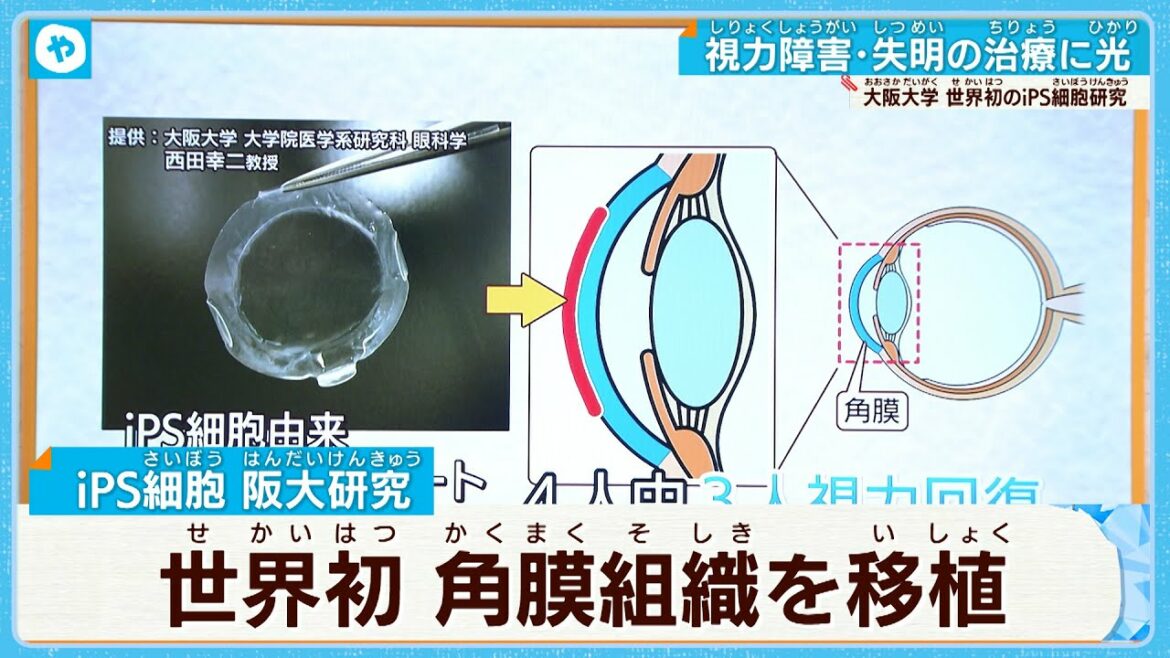【世界初】視力障害〝失明〟の治療に光　iPS細胞から作った角膜組織を移植　大阪大学