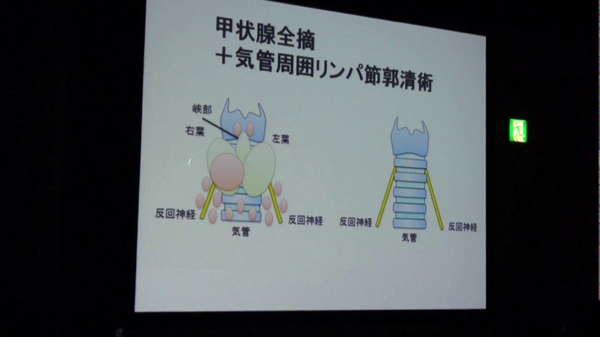 「甲状腺がんの手術について」岩舘学（福島医大）～市民公開講座（２）