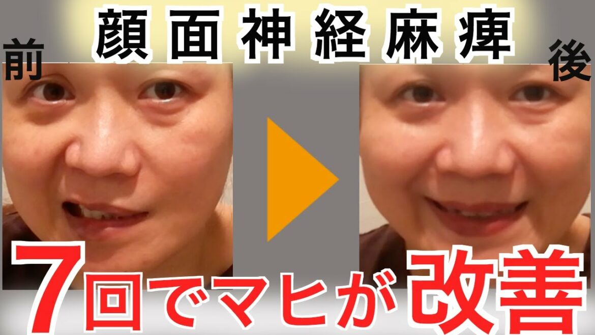 【ハント症候群】７回の鍼治療で改善した例