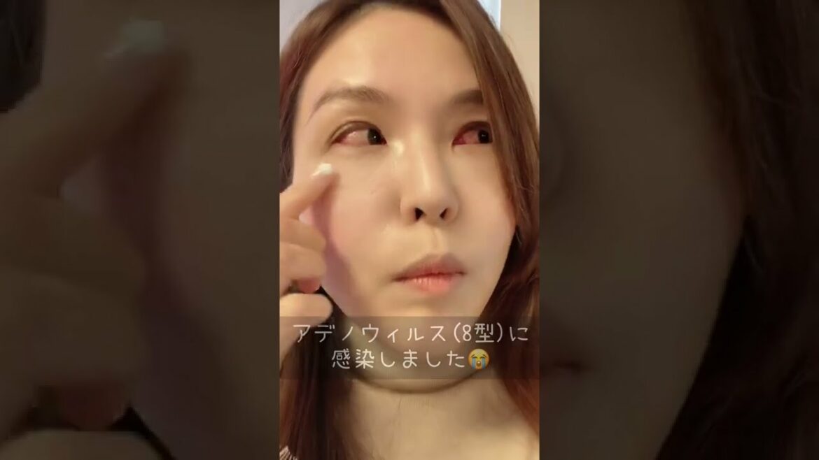 目からアデノウィルスに感染したらこうなります😭　#short
