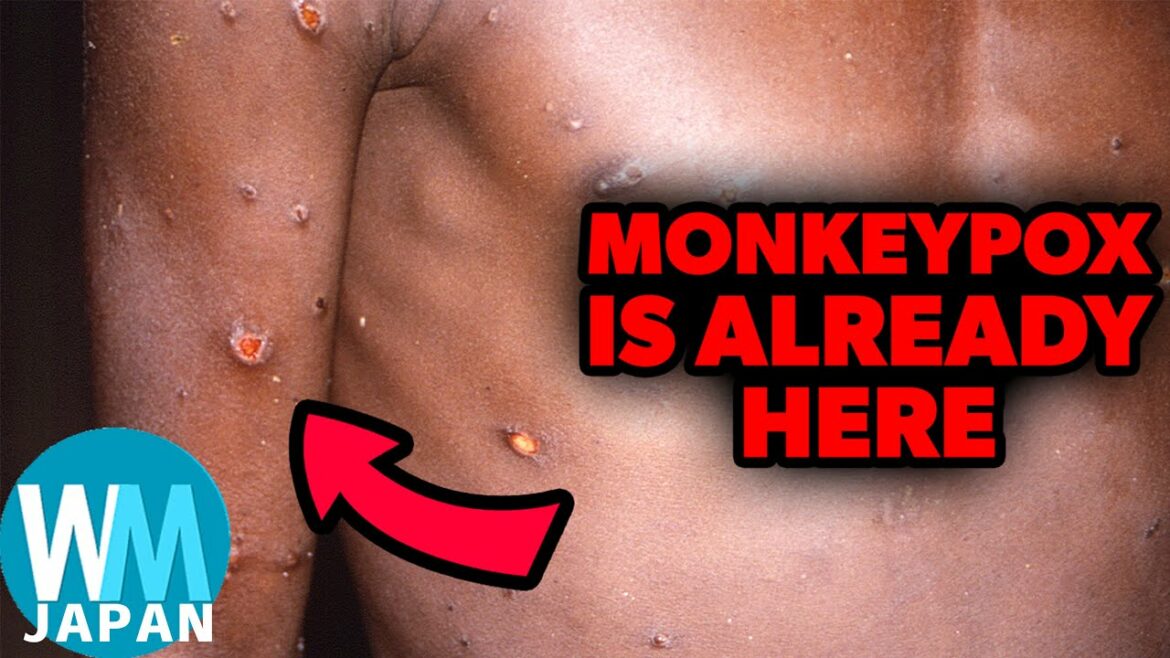 サル痘について知っておくべきこと ランキングTop10 サル痘について知っておくべきこと ランキングTop10