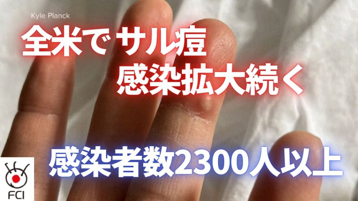 米 サル痘の感染拡大続く 感染者数2300人以上
