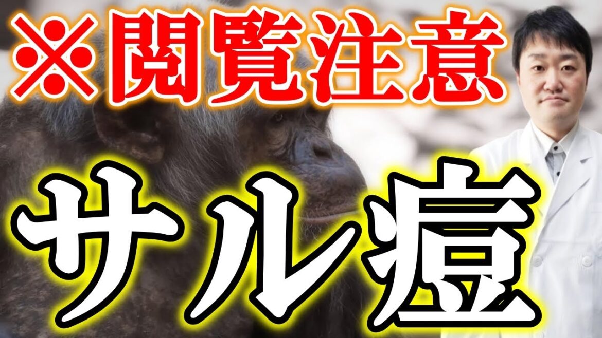 【皮膚に急なぶつぶつ】サル痘が世界で拡大　日本にも上陸？　予防などを医者が完全解説