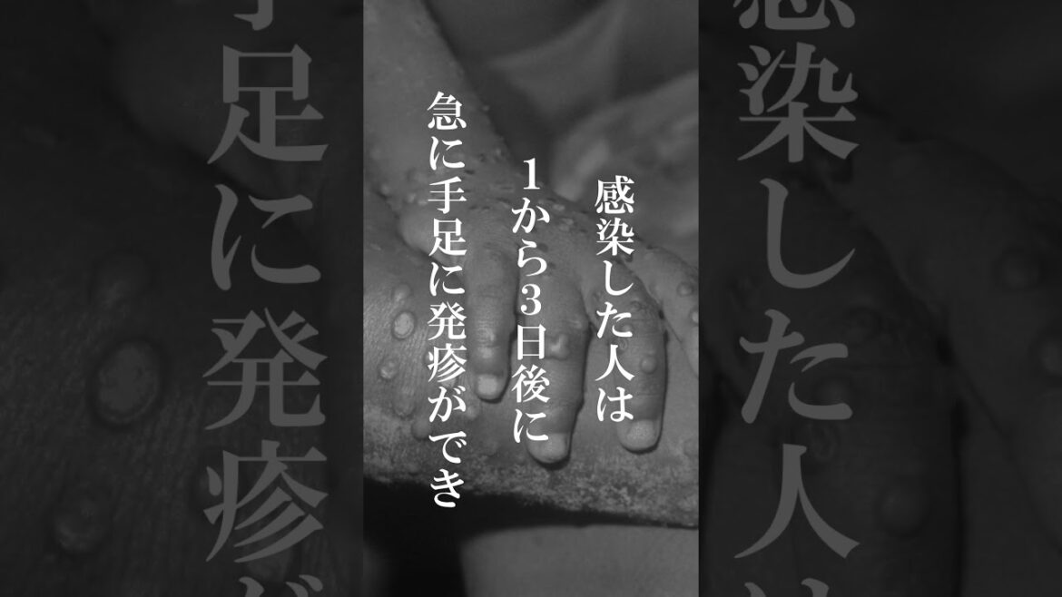 【怖い病気】日本で感染が増加しているサル痘 #shorts #病気  #雑学 #怖い話