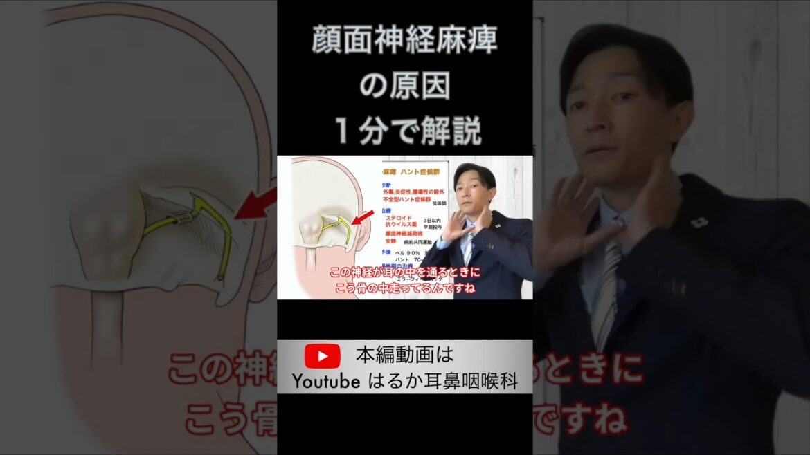 顔面神経麻痺の原因　#shorts 　#顔面神経麻痺　＃ベル麻痺　＃ハント症候群