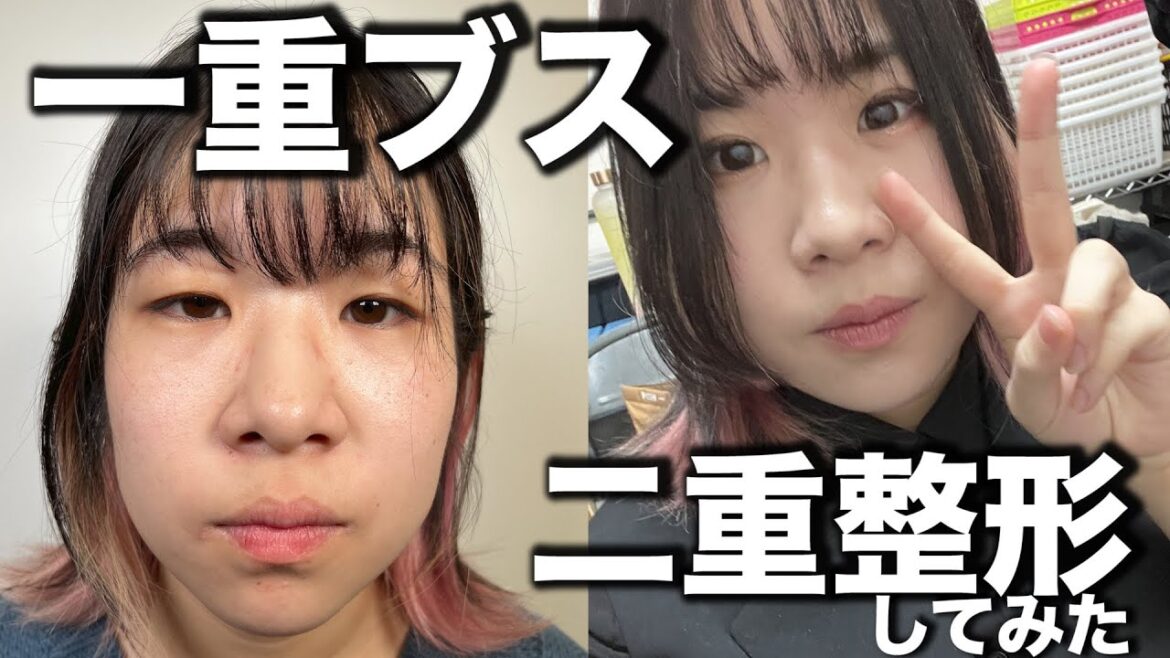 【二重整形】24年間悩んだから埋没やっとしてみた 【二重整形】24年間悩んだから埋没やっとしてみた