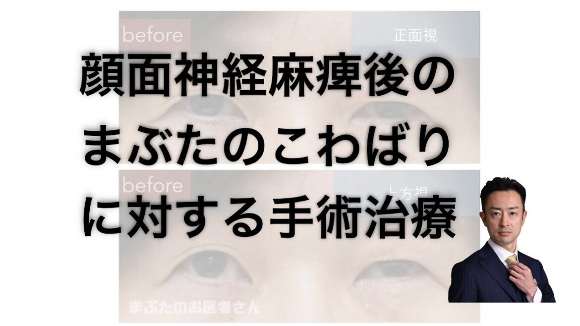 顔面神経麻痺後のこわばりによる眼瞼下垂に対して形成手術を行った