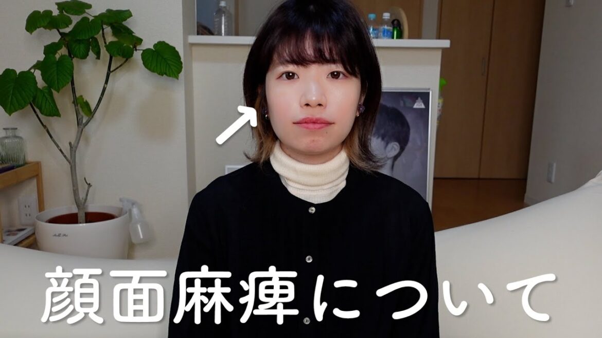 顔面麻痺について。
