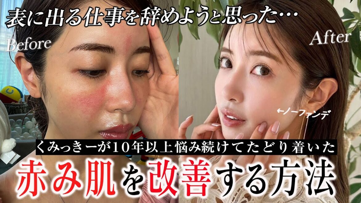 【隠したい過去】赤み肌で自信がなかったくみっきーの人生が変わった方法
