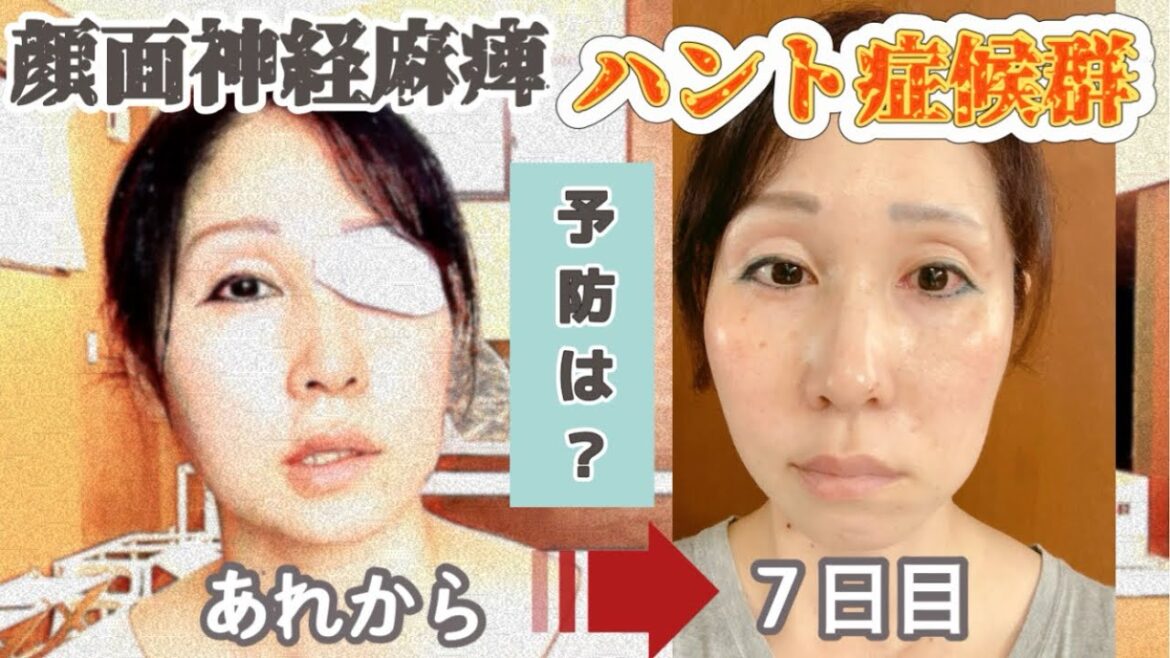 ラムゼイハント症候群(顔面神経麻痺)7日目/予防