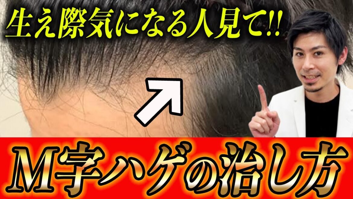 M字ハゲの最適な治療法を解説します【AGA/薄毛改善】
